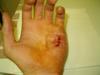 Probably Offtopic: Cut with 3 stitches - It was a lazy friday night, that turned pretty bloody after my 3 bottle cascade try. Absolutely no pain, but still a mark for life :)